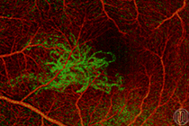 OCT-Angiographie einer altersbedingten Makuladegeneration mit krankhafter Gefäßneubildung in grün. Quelle: MUW